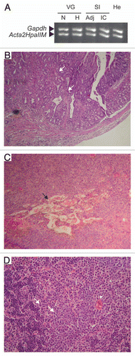 Figure 3 Acta2HpaIIM mice tumors. (A) Representative example of transgene expression in transgenic organs and tumors. VG, vesicular gland; SI, small intestine; N, normal size; H, hyperplastic; Adj, macroscopically normal tissue adjacent to a tumor; IC, intestinal carcinoma; He, hemoangioma. (B–D) Examples of transgenic tumor histology (hematoxylin/eosin). (B) Intestinal carcinoma. An area of well differentiated carcinoma is visible in the lower part, left of arrows (40× magnification). (C) Hemoangioma. The tumor mass surrounds blood vessels with abnormal architecture (arrow; 100×). (D) Lymphoma. Cells with enlarged nuclei (examples indicated by arrows, left) and phagocytes (arrowhead, right) are visible (200×).