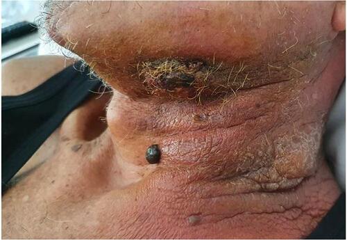 Figure 6 Evolution of the cutaneous sarcoma in a submandibular abscess.