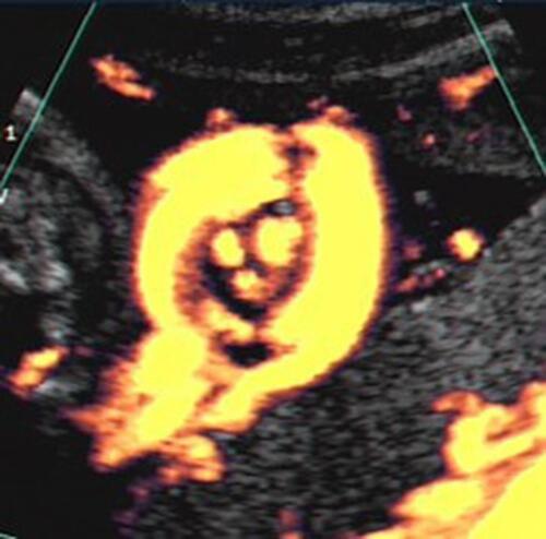 Figure 4 Power Doppler image depicting a true knot of the umbilical cord. Note the “smiley face” features (almost complete circle of umbilical cord [face outline] surrounding “eyes” and “mouth/smile”), representing the en-face presenting two umbilical arteries and umbilical vein, respectively.