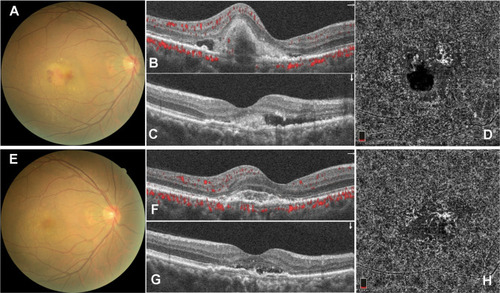 Figure 3 Fudus imaging of nAMD patient 1 before and after IVR. Subretinal hemorrhage and exudation on colour photography (A), optical coherence tomography (B and C) and optical coherence tomography angiography showing choroidal new vessels before IVR (D). Subretinal hemorrhage and exudation was decreased on colour photography (E), optical coherence tomography (F and G) and optical coherence tomography angiography showing choroidal new vessels were shrinked after IVR (H).