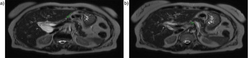 Fig. 1 (a, b) Arrow pointing toward common bile duct dilation.