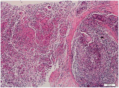 Figure 2. Extensive non-caseating granulomatous mastitis mostly centered around terminal ducts and lobular units. Some granulomatous foci are associated with moderate neutrophilic infiltrate.