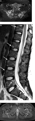 Figure 1 Radiographic findings of spinal and sacroiliac involvement. (A) Axial T2-weighted image of the sacroiliac joints demonstrate fluid within both sacroiliac joints with widening of the left sacroiliac joint. There is bone marrow edema within the sacral ala and adjacent iliac wings (arrows). (B) Sagittal T2-weighted image of the lumbar spine demonstrates triangular-shaped regions of edema along the corners of the vertebral bodies (arrows) consistent with magnetic resonance corner lesions. (C) Axial T1-weighted postcontrast image shows left hip synovitis (black arrow). There is enhancing edema within both greater trochanters and at the hip flexor entheses (white arrows) with mild surrounding soft tissue inflammatory changes. Courtesy of Dr Nancy Chauvin, The Children’s Hospital of Philadelphia, Philadelphia, PA.