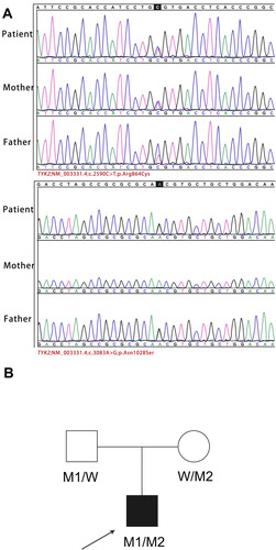 Figure 3 Identification of TYK2 compound heterozygous mutation. (A) Validation by Sanger sequencing of theTYK2 mutations in the patient and his parents. (B) Pedigree of a family in our case. Squares and circles indicate males and females, respectively. Darkened symbols represent the affected individuals. The proband is indicated by an arrow. W, wild-type; M1, c.3083A>G (p.N1028S); M2, c.2590C>T (p. R864C).