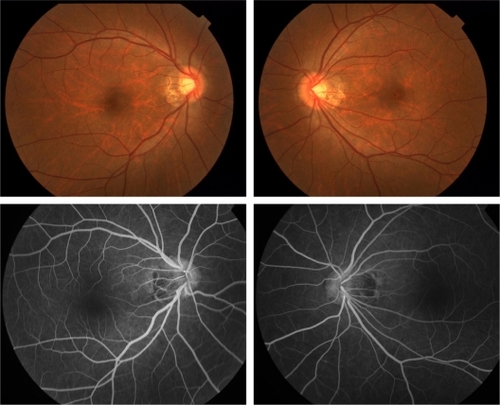 Figure 2 Fundus photograph (above) and fluorescein angiography (below) of case 1 showing no abnormal findings.