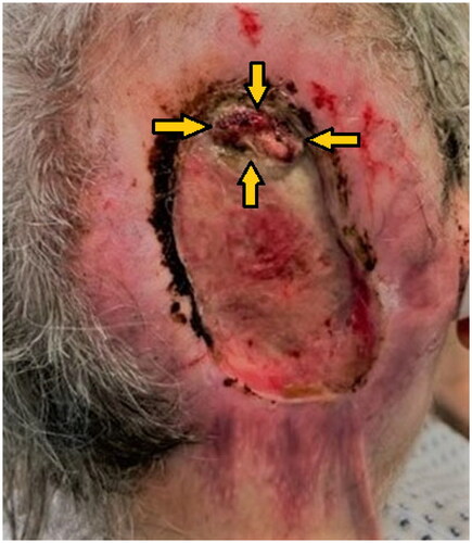 Figure 1. Full-thickness occipital skull defect with circular scar contractures and central exposure of the dura mater (indicated by arrows).