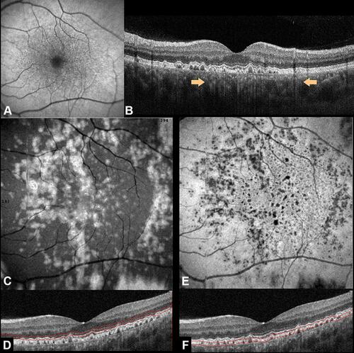 Figure 3 Cuticular drusen recognition using multimodal imaging. (A) Fundus autofluorescence demonstrates multifocal central hypoautofluorescence with hyperautofluorescent border. (B) Spectral-domain optical coherence tomography (OCT) B-scan exhibiting the classical saw-tooth configuration with a hyporeflective internal content and a characteristic bar-code signature (peach arrows) in the choroid. (C) Structural en face obtained through a customized segmentation (D) passing above the plane of drusen (−95, −55 µm offsets) demonstrates their distribution. A structural en face customized view (−34, 6 µm offsets) passing through the drusen (E and F) highlights the hyporeflective cores of the cuticular drusen.