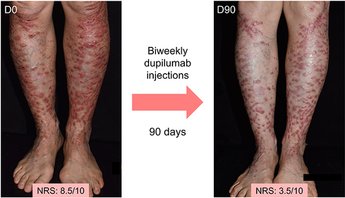 Figure 5 Treatment effect of intravenous biweekly dupilumab injections in DDEB. A 59-year-old patient with DDEB (EB pruriginosa) displays flattening and less erythema of the prurigo-like papules and nodules on both lower legs after biweekly dupilumab injections for 3 months. The itch numerical rating score also decreased from 8.5 to 3.5.