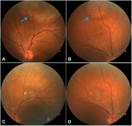 Figure 5 Dilated fundus examination of the 45-year-old male patient previously treated for breast cancer revealed a round relatively bump yellow-white choroid mass superior to the optic disc with serous leakage in each eye (left: (A); right: (B)). The lesions were annotated with blue arrows. Six months after being treated with fulvestrant and CDK4/6 inhibitor, the choroidal lesions regressed (left: (C); right: (D)).