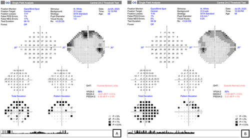 Figure 10 (A, B) HVF testing a week after initial diagnosis with better reliability with defect in both eyes.