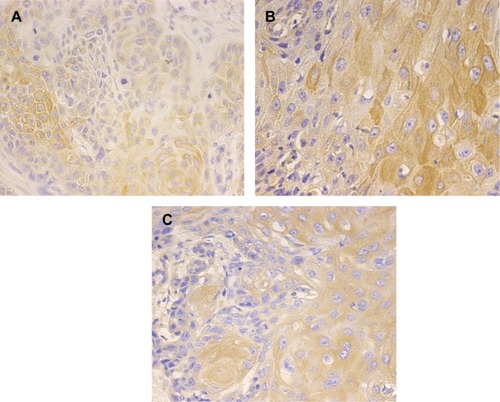 Figure 1 The expression of HPV16 E6, p75NTR, and PI3K in ESCC tissues detected by immunohistochemical staining.