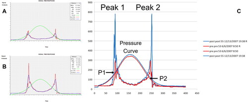 Figure 7. Sample Ocular Response Analyzer waveforms from (A) a healthy individual and from (B) an individual with keratoconus, showing blunted peaks in keratoconus. Peaks occur when the cornea is applanated. The y-axis is number of photons aligned with the detector of the device, and the x-axis is time (ms). The green trace is air pressure created by the piston of the device. The red and blue traces are the unfiltered and filtered, respectively, number of photons reaching the detector. (C) Two sets of waveforms generated by the Ocular Response Analyzer from a patient with keratoconus before cornea crosslinking (red) and one year after cornea crosslinking (blue). Note the difference in the applanation pressures does not change, despite the greater peaks in the post-op blue waveforms, indicating stiffening of the cornea. Adapted from Roberts.Citation8