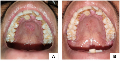 Figure 1 Painless single ulcer, with a red base, white edges on the palate (A). Lesions healed in second visit, 14 days later (B).