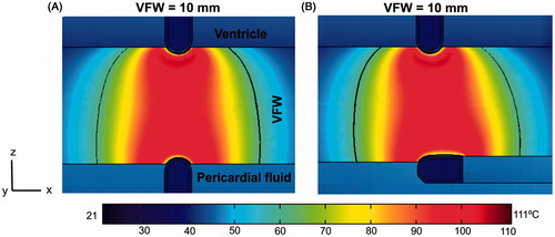 Figure 7. Temperature distributions after 120 s of RFA with BM across VFW (10 mm thickness) comparing two orientations of the epicardial catheter: (A) perpendicular and (B) parallel to the epicardium. The solid black line is the thermal damage border (Ω = 1).
