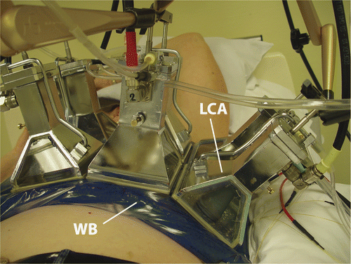 Figure 2. A 2 × 3 LCA array and water bolus (WB) placed on the chest of a patient.