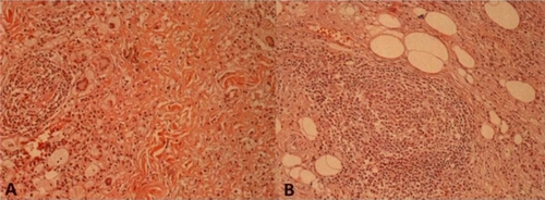 Figure 3 Diffuse infiltrate rich in lymphocytes, foamy histiocytes, and giant cells (hematoxylin and eosin: x250). A) Giant cells of Touton type, B) nodular lymphoid infiltrate.