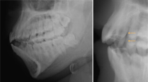 Figure 4. First-line postmortem 2 D radiographs, no dental care, complete arches few (mostly morphometric) data. On the right, there are only two orthodontic retainers (arrows).