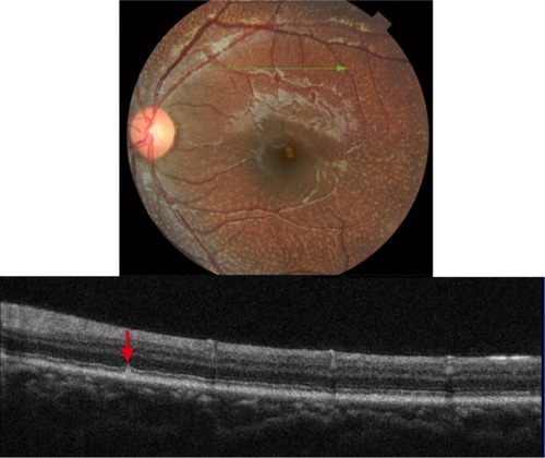 Figure 15 The B-scan line on the fundus photograph (top) has the same width as the B-scan SD-OCT image (bottom) demonstrating the appearance of early deposits in fundus albi (red arrow).