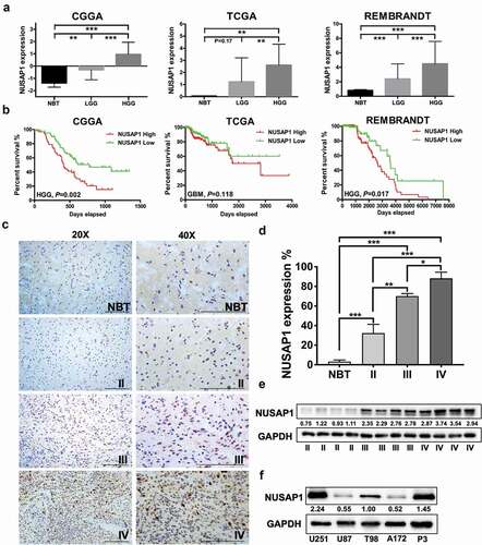 Figure 1. NUSAP1 expression is up-regulated in high grade gliomas and inversely associated with glioblastoma patient prognosis. A. Relative expression levels of NUSAP1 mRNA in normal brain (NBT), low grade glioma (LGG) and high grade glioma tissue samples from the CGGA, TCGA and rembrandt databases. **P < 0.01 and ***P < 0 .001. B. Kaplan-Meier analyses showing differences in overall survival for patients with low and high NUSAP1 expressing gliomas from CGGA, TCGA and rembrandt databases. C. Representative images of immunohistochemical staining for NUSAP1 in 4-μm sections from normal brain tissue samples (NBT), and grade II, III and IV (GBM) gliomas. Scale bar = 100 μm. D. Immunohistochemical scores for NUSAP1 in normal brain tissue samples (NBT), and grade II, III, and IV (GBM) gliomas. Five random fields from each section were counted. Data are shown as the mean ± SD. *P < 0.05, **P < 0 .01 and ***P < 0.001. E. Western blot analysis of NUSAP1 levels in grade II, III and IV gliomas. F. Western blot analysis of NUSAP1 levels in U87, A172, U251,T98 and GBM patient derived P3 cell lines.