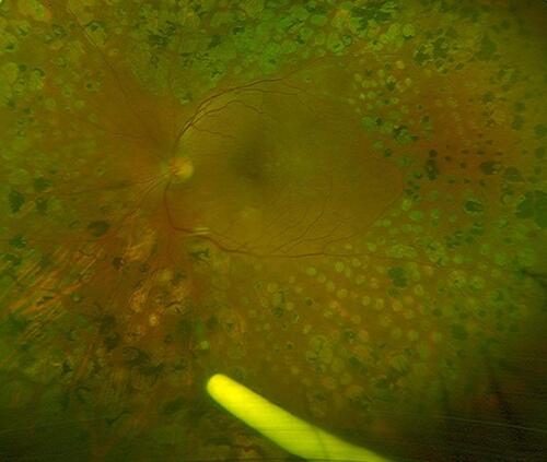 Figure 1 Ultra-wide field image showing dexamethasone implant in the inferior vitreous in a patient with lasered proliferative diabetic retinopathy and recurrent macular edema.