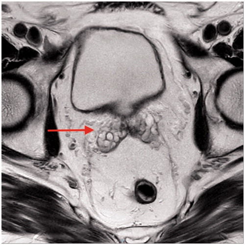 Figure 2. MRI T2 weighted image showing a right seminal vesicle bleed.