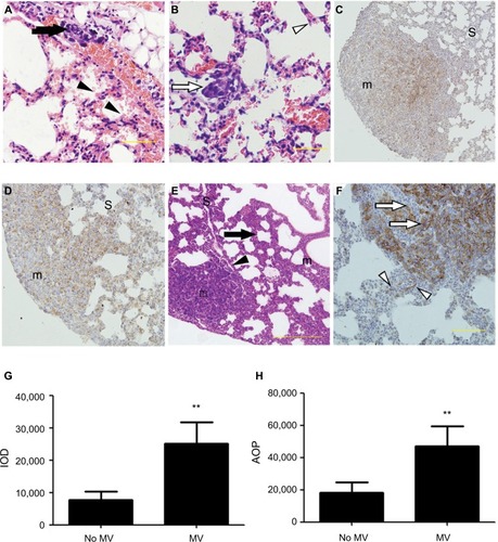 Figure 2 (A–F) Representative histological view and images of immunohistochemical staining using anti-EpCAM body in the lung treated with MV or without MV. H&E stain of lung sections (A and B) shows micro-metastases formation and mild lung injury 24 h after intravenous 4T1 cells inoculation and MV treatment (Protocol A). Bar: 50 µm. (A) Arrow shows the presence of small-blood-vessel hemorrhaging and vascular congestion of tumor emboli. The majority of tumor cells were found lining the interior of blood vessels. However, a few tumor cells were found spreading into the surrounding tissue in the areas wherein blood vessel integrity was lost (indicated by an arrowhead). Note the presence of minimal interstitial edema and increase in intravascular and interstitial inflammatory cells in the same areas (indicated by an arrowhead). (B) Empty arrow shows the presence of a single tumor nodule within a lung parenchyma injury field (the “seeding” region) and empty arrowhead indicates normal lung parenchyma, whereas the lungs show intact blood vessels, bronchioles, and alveolar spaces. (C) Low power (×10) photomicrograph of anti-EpCAM immunohistochemical staining in lung tissue sections taken from BALB/c mice in the control group (28 d after 5×105 4T1 cells were injected into the mammary fat pad, untreated with MV during surgical procedures 14 d after inoculation [Protocol B]). The arrowhead indicates weak EpCAM immunohistochemical staining in 4T1 cells in the central part of a single tumor nodule. Intact surrounding lung parenchyma is negative for EpCAM. m, tumour nodule. (D) Treated MV during surgical procedures (Protocol B) shows that almost all 4T1 cells express EpCAM in a single tumor nodule. Weak-to-moderate EpCAM immunohistochemistry staining was observed in the surrounding lung parenchyma. H&E staining of lung sections (E) shows extensive tumor cell metastasis and lung architecture destruction. Arrows show diffuse increase of interstitial cellularity, with both mononuclear cells and neutrophilic infiltration; the arrowhead indicates blood vessel formation within the tumor nodule. Bar: 100 µm. (F) High-power (×40) photomicrograph of lung, 28 d after 5×105 4T1 cells were injected into the mammary fat pad, treated with MV during surgical procedures, and 14 d after inoculation (Protocol B), 4T1 tumor cells were observed with strong membrane or cytoplasmic staining of EpCAM within the tumor nodule (indicated by empty arrows) and a few epithelial cells with strong cytoplasmic EpCAM immunohistochemical staining were observed surrounding the tumor nodule (indicated by empty arrowhead). Bar: 50 µm. (G) Quantification of EpCAM with integrated optical density (IOD) in the lung metastatic tumor nodule of the MV exposure group and control group by immunohistochemical staining. Data presented as mean±SD, n=4; the ** indicates statistical significance, P<0.01. (H) Quantification of EpCAM with the area of positive staining (AOP) in lung metastatic tumor nodules in the MV exposure group and control group. Data presented as mean±SD, n=4; the ** indicates statistical significance, P<0.01.Abbreviations: d, days; EpCAM, epithelial cell adhesion molecule; h, hours; m, tumor nodule; MV, mechanical ventilation; S, surrounding lung parenchyma.