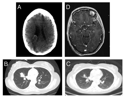 Figure 3. Radiographic findings in patient 2. (A) An initial CT-scan of the brain showed 3 large lesions, one of which is seen in this axial image abutting the posterior right lateral ventricle. (B) The primary tumor likely arised from the right middle lobe adjacent to the hilum. (C) After 6 mo of Crizotinib monotherapy, the tumor in the right lower lobe exhibited a significant partial response. (D) An MRI of the brain after undergoing 8 mo of Crizotinib showed the interval development of multiple new metastases.