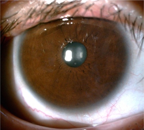 Figure 3 Four months after surgery, the corneal flap is clear and smooth in situ without epithelial ingrowth.