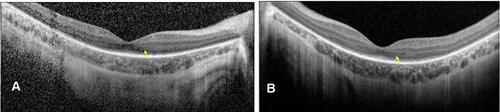 Figure 2 Optical coherence tomography images of the right (A) and left (B) macula of a 6-year-old boy with biallelic RPE65 gene mutation. Notice the diffuse loss of the ellipsoid zone except for a small subfoveal island in both eyes. Also note the marked atrophy of the outer nuclear layer (arrows) which slightly increases in thickness in the parafoveal and foveal regions.