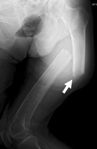 Figure 4. Case 2. The left femur showed cortical thickening with a jagged pattern (arrow).