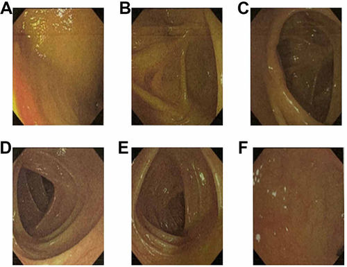 Figure 2 Quality of bowel preparation on March 27, 2023. (A) Terminal ileum, (B) appendix Opening; (C) ileocecal lesion; (D) Transverse colon; (E) Descending Colon; (F) Retrum. The BBPS score significantly improved from 3 to 8 on March 27, 2023. This enhancement indicates successful bowel preparation, with clear mucosal visibility and minimal to no residual fecal matter across all three colon segments.