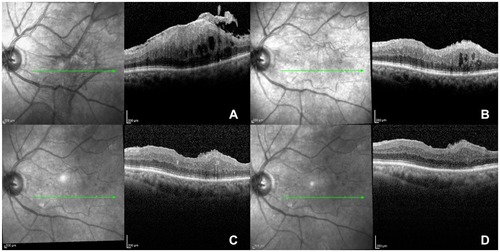 Figure 2 Preoperative and Postoperative SD-OCT scans of patients with stage 4 ERM and intraretinal cysts undergoing 25G VVP plus intraoperative DEX implant. (A) Baseline stage 4 ERM with intraretinal cysts. (B) At 1 month after surgery, despite significant retinal thinning, few cysts are present. (C) At 3 months after surgery, intraretinal cystoid changes completely resolved. (D) At 6 months after surgery, the clinical picture remains stable. A good anatomical restoration is achieved.