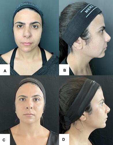 Figure 6 Woman, 34 years old; (A and B) Before procedure; (C and D) 180 days after procedure: slimming of the middle third of the face and improvement of the skin laxity.