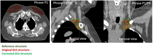Figure 3. Examples of deviations from guidelines by using the DLS model to generate breast (left) and axillary lymph node level 4 (middle and right). Uncorrected model generated volumes are shown in red, reference volumes (manual delineations) are shown in dark green and corrected DLS volumes are shown in bright green. The example shows a DLS generated breast that is incomplete/speckled cranially (P1) and a DLS generated axillary lymph node level 4 that is incompletely outlined cranially and caudally (P1/P4).