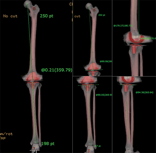 Figure 1. Preoperatively, the mechanical axis deviation, femoral coronal angle, tibial coronal angle, femoral sagittal angle, and tibial sagittal angle were measured by 3-dimensional CT scanning.