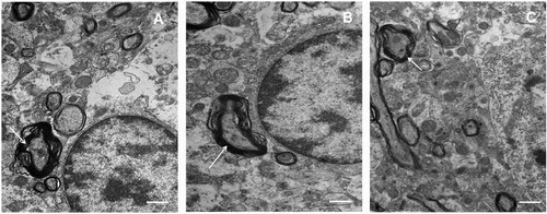 Figure 3. Electron microscopic examination of somatosensory cortex with global and focal ischaemia. Splitting myelin sheaths (arrow) is present in all samples. The scale bar is 2 μm. (A) Control (sham-operated); (B) bilateral occlusion of the common carotid arteries (BCAO); (C) middle cerebral artery occlusion (MCAO).