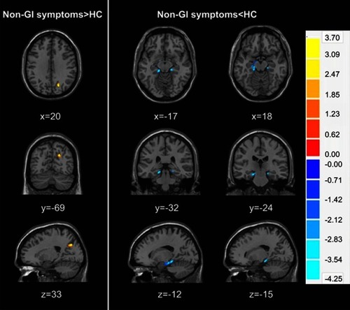 Figure 3 Regional GM volume differences between non-GI symptoms group and HCs group displayed on axial, coronal and sagittal slices. Numbers indicate x, y and z slices and are displayed in MNI coordinates. Red and blue colors denote increased and decreased GM volume. The color bars indicate the T-value based on two-sample t-test. (voxel- P <0.01, cluster- P <0.05, cluster size>50, GRF correction).Abbreviations: HC, healthy control; GM, gray matter; MNI, Montreal Neurological Institute; GI:  gastrointestinal symptom; GRF, Gaussian Random Field.