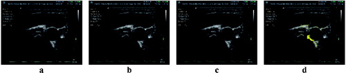 Figure 5. Image with missing artery parts (a); artery part repaired using a reference image and the image with missing parts artery for correction (b); repaired artery parts, completed by an average of the values of reference images (c); fixed artery part with a user defined colour (d).