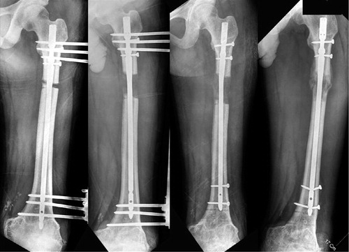 Figure 2 (case 12). Lengthening over a nail was done in an 18-year-old man. After gaining 5 cm, the external fixator was removed. 5 months after the operation, the distracted segment was slightly collapsed, with breakage of locking screws.