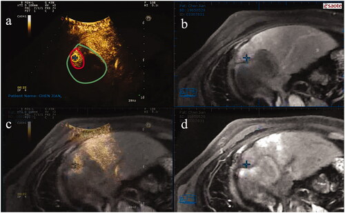 Figure 4. A representative case for VN-guided RFA. (a) CEUS demonstrates residual viable HCC with red border. The green boundary area represents the entire post-TACE area; (b) The cross marks the active area after TACE on CEMRI image; (c) The superposition of CEUS, CEMRI and MRI image; (d) The cross marker is an active part of HCC in MRI image, indicating the incomplete deposition of lipiodol. VN: virtual navigation; RFA: radiofrequency ablation; CEUS: contrast-enhanced ultrasound; HCC: hepatocellular carcinoma; TACE: transcatheter arterial chemoembolization; CEMRI: contrast-enhanced magnetic resonance imaging; MRI: magnetic resonance imaging.