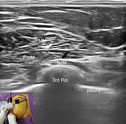 Figure 1 Type II pectoral nerve block guided by ultrasound.