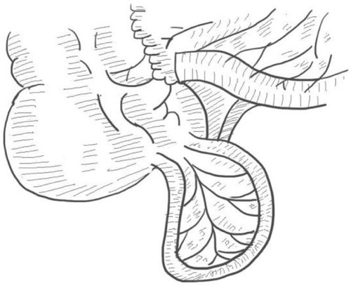 Figure 4 Frontally displaced mesentery (our case is of this type).