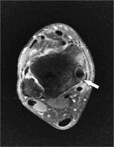 Figure 3. Tibialis posterior tendon tenosynovitis (arrow) on fat-saturation gadolinium injected T1-weighted axial MRI.