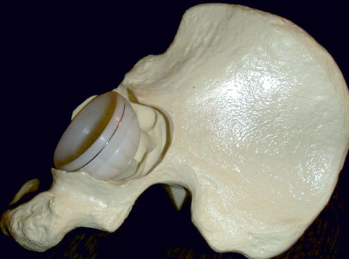 Figure 1. Combined segmental and cavitary osteolytic bone defects of the acetabulum.