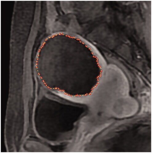 Figure 1. MicroSea 3D Image Processing Software was used to sketch the non-perfused volume layer by layer on contrast-enhanced magnetic resonance imaging.