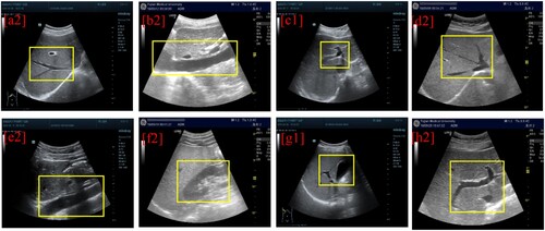 Figure 1. The [a2]-[h2] represents the example of the eight categories of LUSP with the feature of each category in the yellow box: (a2) HV: the hepatic vein are visible, (b2) IVC: In this view, we can see the inferior vena cava, (c2) FPH show the short axis of the dominant portal vein and the thick left and right branches are displayed on the right side of the hepatic portal groove, (d2) SPH show the proximal end of the hepatic vein, (e2) AA show longitudinal section of left outer lobe of the liver, (f2) LRK show portal vein branch inside the right lobe of the liver, (g2) LG show the right liver short-axis cross-section of the anterior lobe, (h2) LLL show left liver lobe.