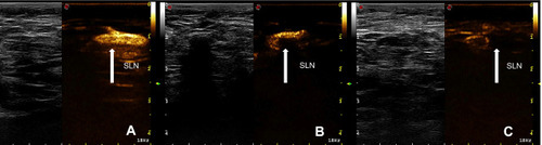 Figure 3 Three types of SLN enhancement patterns. (A) Type I, SLN presented significantly homogenous enhancement (arrow). (B) Type II, SLN showed significant heterogeneous enhancement (arrow). (C) Type III, SLN showed weak enhancement (arrow).
