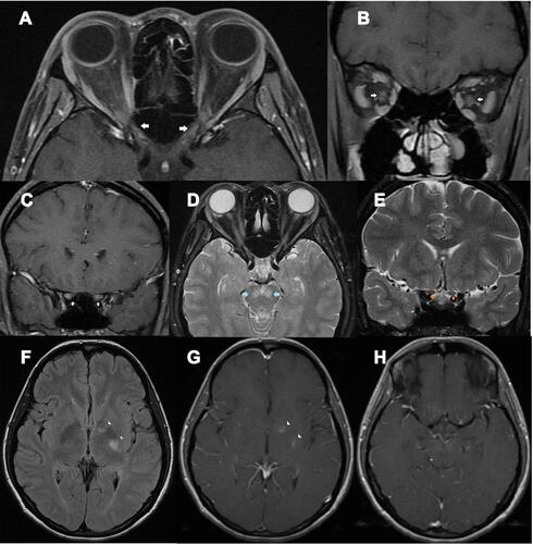 Figure 1 A 39-year-old HIV-infected female presented with bilateral optic neuritis and cryptococcal meningitis. (A) axial contrast-enhanced T1-weighted images with fat suppression showed enhancement of both optic nerves at the intraorbital, intracanal, and intracranial segments (arrows); (B) coronal contrast-enhanced T1-weighted images with fat suppression showed enhancement of both optic nerves at the intraorbital segments (arrows); (C) coronal contrast-enhanced T1-weighted images with fat suppression showed enhancement of both optic nerves at the intracranial segments (arrows); (D) Axial T2-weighted images with fat suppression showed signal hyperintensity at both cerebral peduncles (arrows) and intraorbital optic nerves; (E) Coronal T2-weighted images with fat suppression showed intracranial optic nerve signal hyperintensity (arrows); (F) axial fluid-attenuation inversion recovery images of the brain showed signal hyperintensity at the genu and posterior limb of left internal capsule (arrowheads); (G) axial contrast-enhanced T1-weighted images of the brain showed abnormal enhancement at the genu and posterior limb of left internal capsule (arrowheads); (H) axial contrast-enhanced T1-weighted images of the brain showed mild leptomeningeal enhancement, suggestive of meningitis.