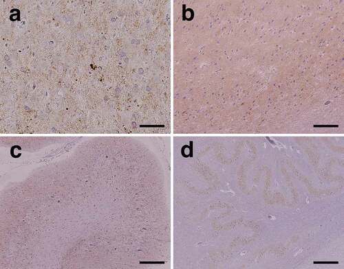 Figure 4. Representative microscopic findings of anti-prion protein (PrP) immunostaining. (a) Diffuse fine granular PrP deposition (synaptic-type) is recognized in the cerebral neocortex. Small plaque-like deposition is scattered (middle temporal gyrus). (b) In the limbic system, diffuse synaptic-type PrP deposition is observed (subiculum). (c) In the cerebellar cortex, PrP deposition is extensively observed in the molecular and granule cell layers. (d) PrP deposition is observed in the inferior olivary nucleus. Scale bars: a: 50 μm; b, c: 200 μm; d: 500 μm