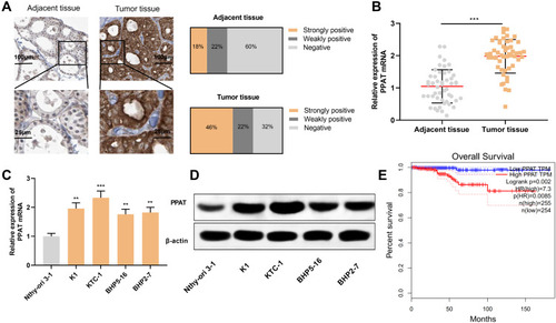 Figure 1 PPAT was highly expressed in TC tissues and cells. (A) We used IHC to detect the expression of PPAT protein in tissue samples from 50 TC patients and 50 normal thyroid tissues. (B) qRT-PCR was used to detect the expression of PPAT mRNA in TC tissues and normal thyroid tissues. (C) qRT-PCR was used to detect PPAT mRNA expression in normal thyroid follicular epithelial cells and TC cells. (D) Western blot was used to detect PPAT protein expression in normal thyroid follicular epithelial cells and TC cells. (E) The relationship between the expression of PPAT and the prognosis of TC patients was analyzed by GEPIA database. The experimental results were analyzed by Student’s t-test, and the difference was statistically significant with P < 0.05. **P < 0.01 and ***P < 0.001.